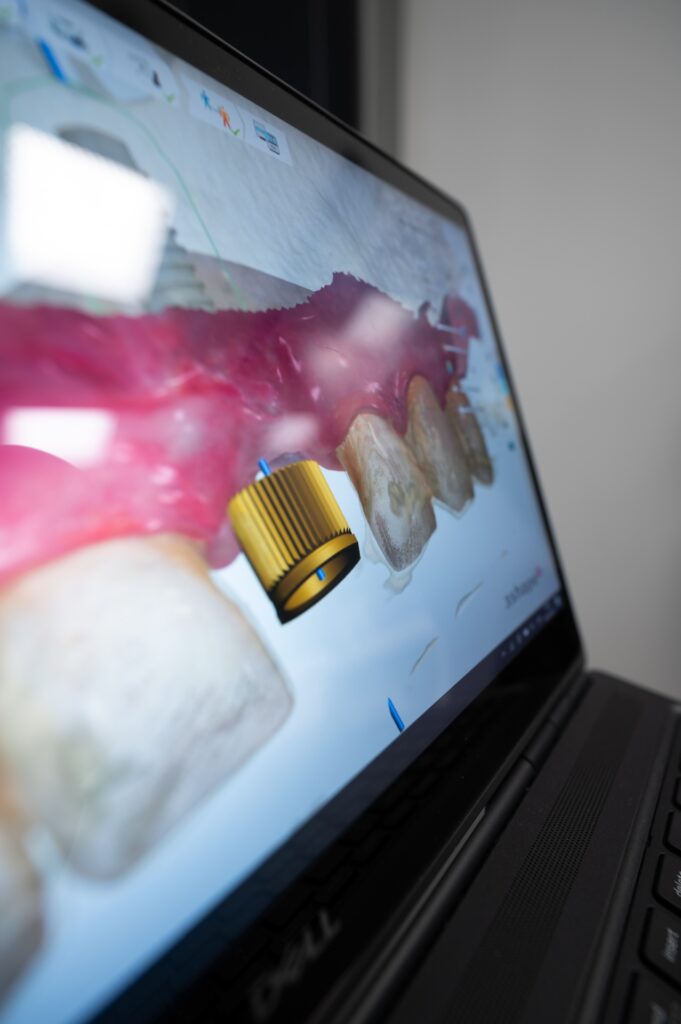 Kvalident impla.cz DSC 2162 Zubni implantaty